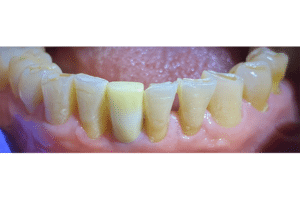 After Image: Dental Implant in the Anterior Esthetic Zone