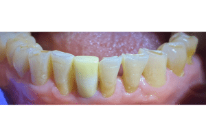 Dental Implant in the Anterior Esthetic Zone