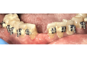 Before Image: Dental Implant in the Anterior Esthetic Zone