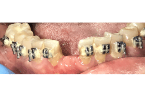 Dental Implant in the Anterior Esthetic Zone