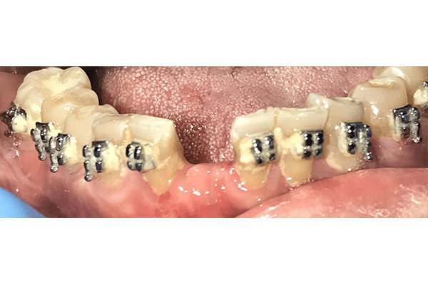 Before Image: Dental Implant in the Anterior Esthetic Zone - front