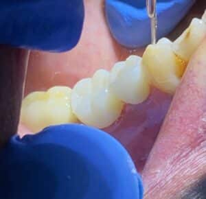 After Image: Dental Implants in the Posterior Region
