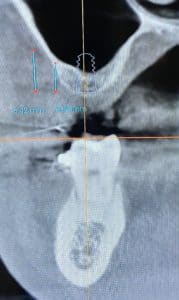 Before Image: Dental Implant in the Maxillary Posterior Region
