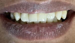 After Image: 2 Dental Implants in the Anterior Esthetic Zone