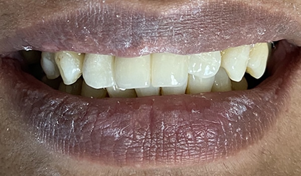 After Image: 2 Dental Implants in the Anterior Esthetic Zone - front