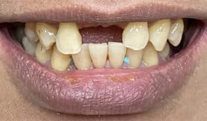 Before Image: 2 Dental Implants in the Anterior Esthetic Zone