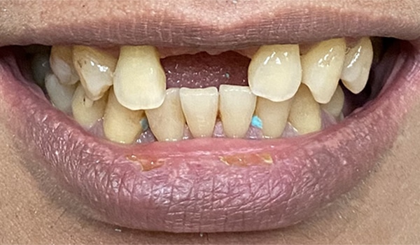 Before Image: 2 Dental Implants in the Anterior Esthetic Zone - front