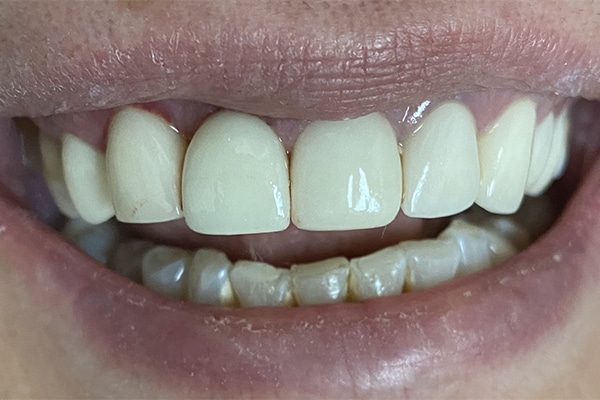 After Image: Dental Implant in the Anterior Esthetic Zone - front
