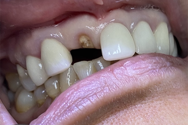 Before Image: Dental Implant in the Anterior Esthetic Zone - front
