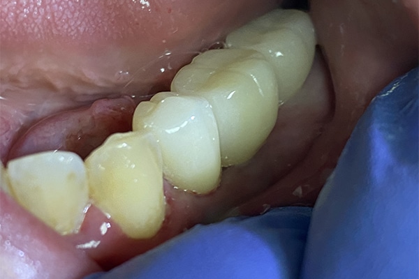 After Image: Multiple Dental Implants in the Posterior Region - front