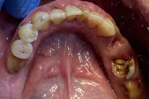 Multiple Dental Implants in the Posterior Region