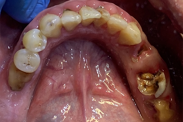 Before Image: Multiple Dental Implants in the Posterior Region - front