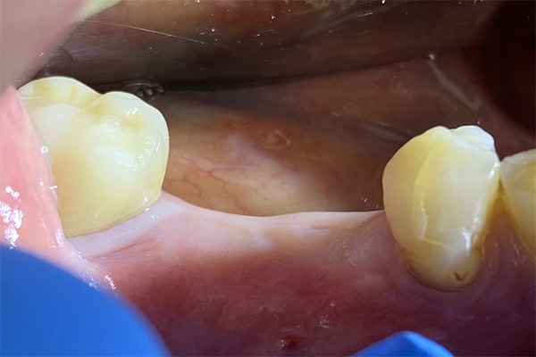 Before Image: Dental Implants in the Posterior Region - front