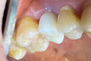 Dental Implant in the Maxillary Posterior Region