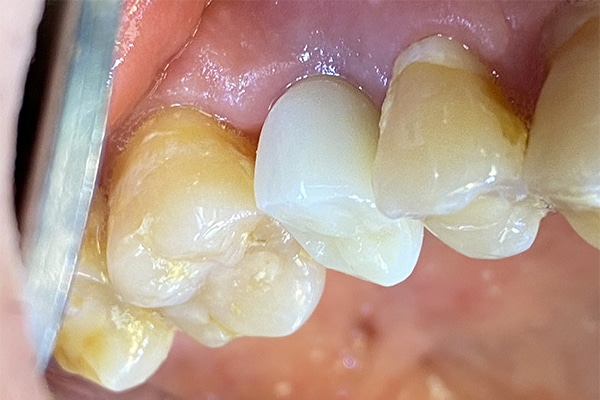 After Image: Dental Implant in the Maxillary Posterior Region - front