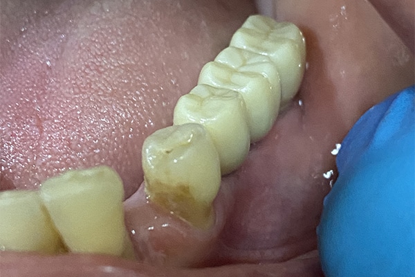 After Image: 3 Dental Implants - front