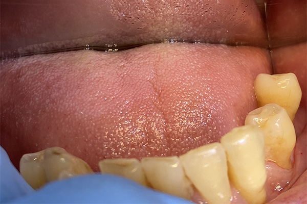Before Image: 3 Dental Implants - front