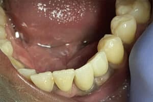 After Image: 2 Dental Implants in the Anterior Esthetic Zone