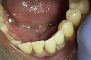 2 Dental Implants in the Anterior Esthetic Zone