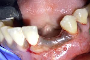 Before Image: 2 Dental Implants in the Anterior Esthetic Zone