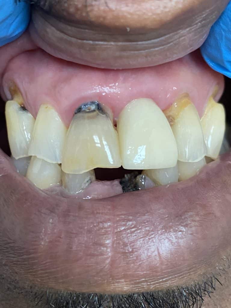 After Image: Dental Implant in the Anterior Esthetic Zone - front