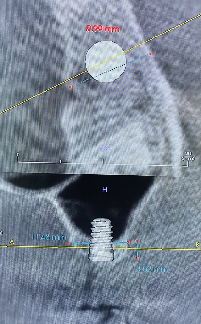 Before Image: Dental Implant in the Posterior Region - front