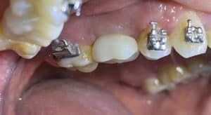 After Image: Dental Implant in the Posterior Region
