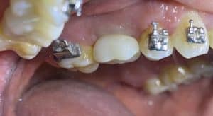 Dental Implant in the Posterior Region