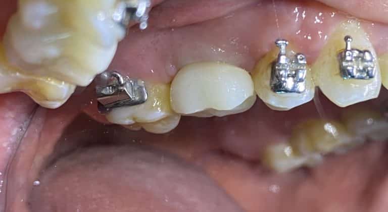After Image: Dental Implant in the Posterior Region - front