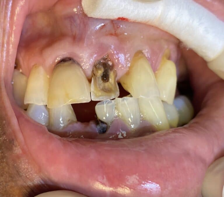 Before Image: Dental Implant in the Anterior Esthetic Zone - front