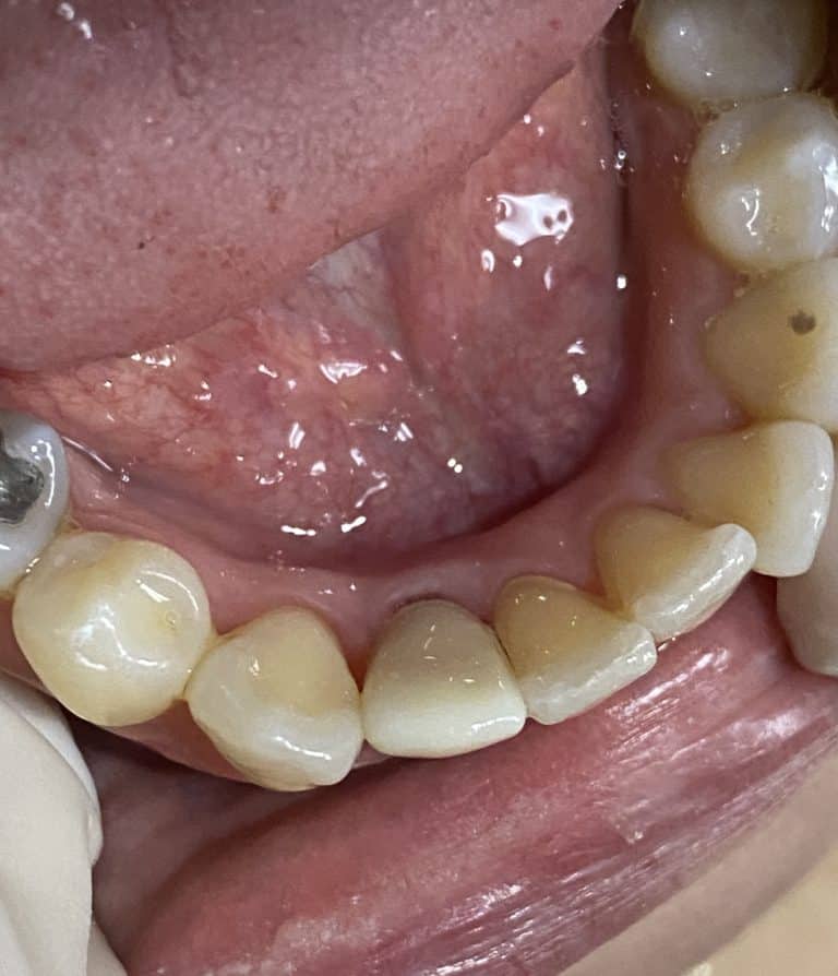 After Image: Dental Implant in the Anterior Esthetic Zone - front