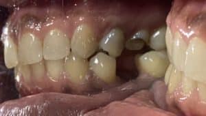 Dental Implant in the Posterior Region