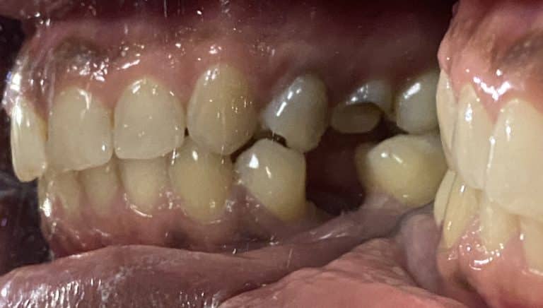 Before Image: Dental Implant in the Posterior Region - front