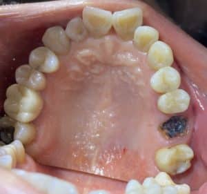 2 Dental Implants in the Posterior Region