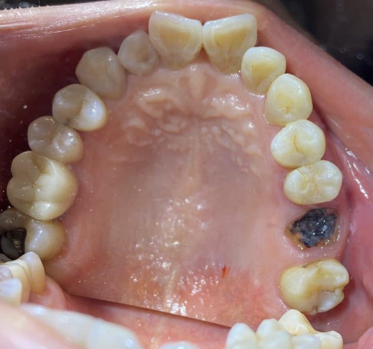 Before Image: 2 Dental Implants in the Posterior Region - front