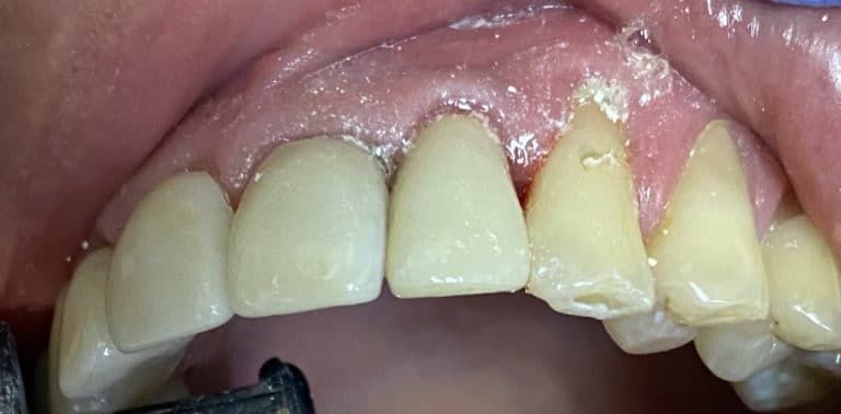 After Image: Dental Implant in the Anterior Esthetic Zone - front