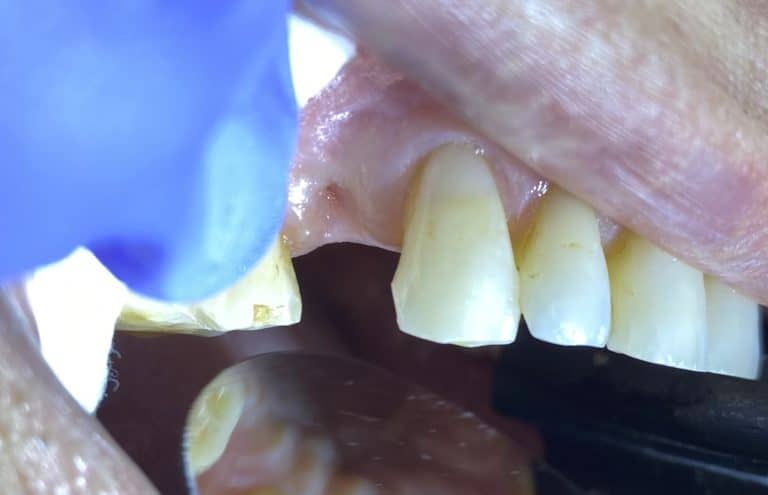 Before Image: Dental Implant in the Posterior Region - front