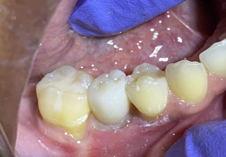 After Image: Dental Implant in the Posterior Region - front