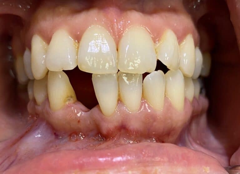 Before Image: Dental Implant in the Anterior Esthetic Zone - front