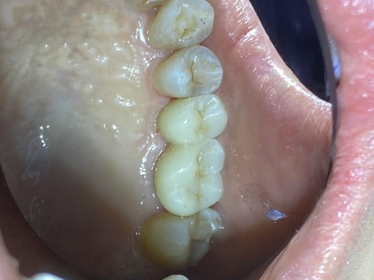 After Image: 2 Dental Implants in the Posterior Region - front