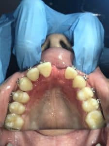 Before Image: Dental Implant in the Anterior Esthetic Zone