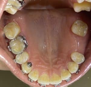 Before Image: Dental Implant in the Posterior Region