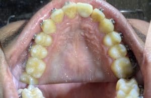 After Image: Dental Implant in the Anterior Esthetic Zone