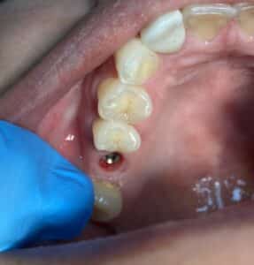 Before Image: Dental Implant in the Posterior Region