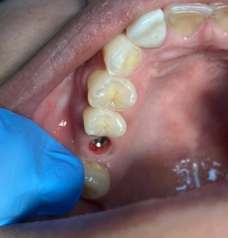 Before Image: Dental Implant in the Posterior Region - front