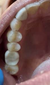 Dental Implant in the Posterior Region