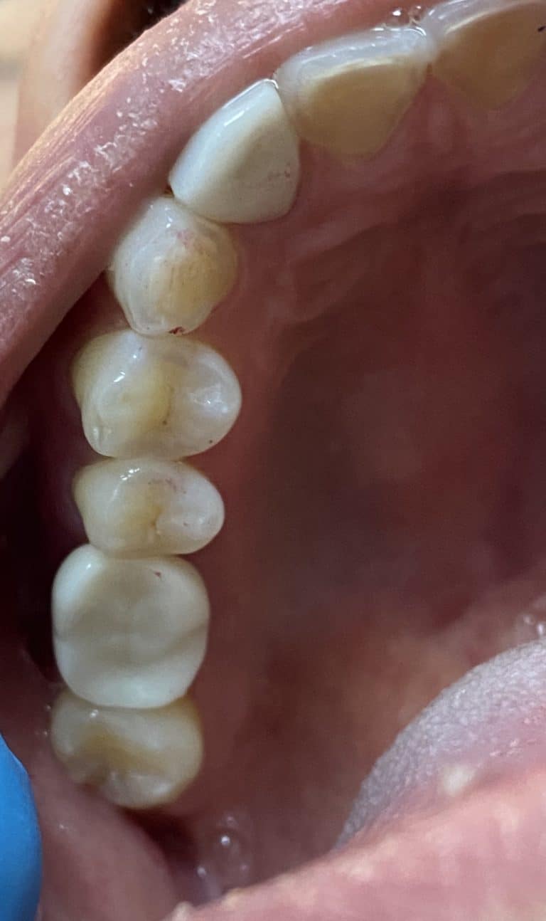 After Image: Dental Implant in the Posterior Region - front