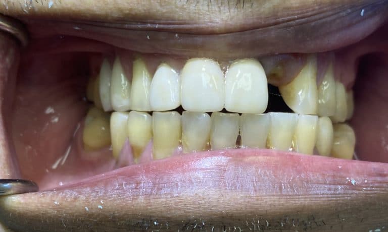 Before Image: Dental Implant in the Anterior Esthetic Zone - front