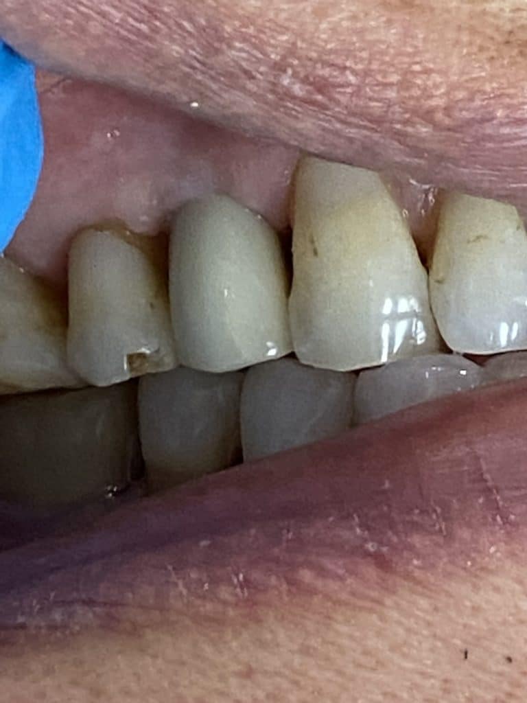 After Image: Dental Implant in the Posterior Region - front