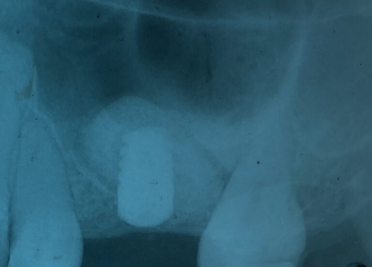 After Image: Dental Implant in the Posterior Region - front